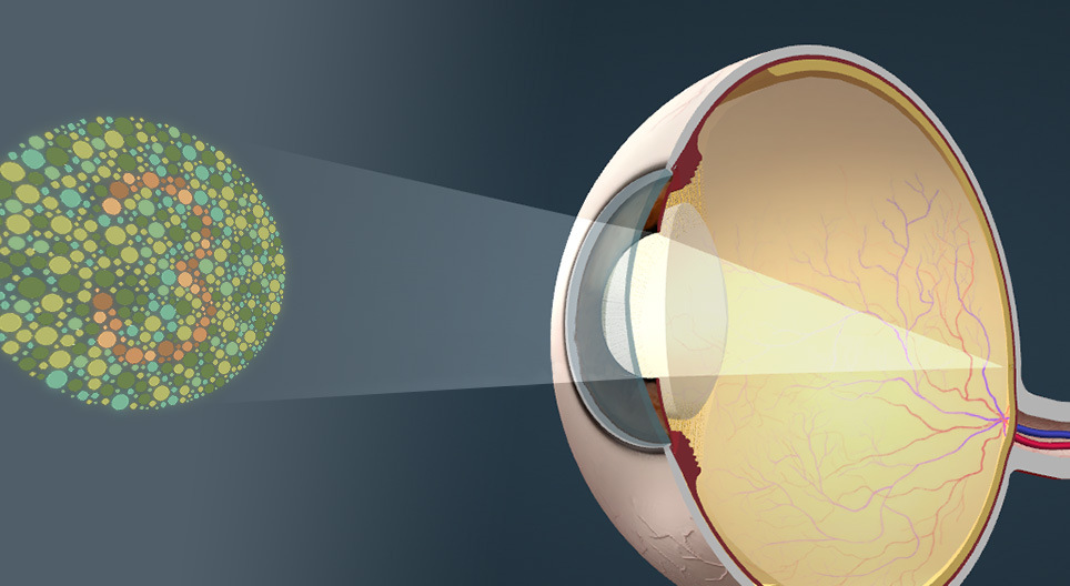 Color vision deficiency