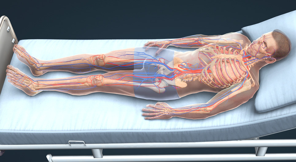 Trombosis venosa profunda y embolia pulmonar