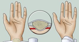 Applying a pressure bandage