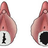 Hymen of young girl (left) and woman living active sexual life (right)