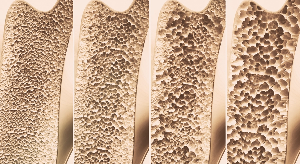 Osteoporosis