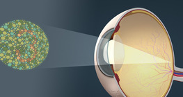 Colour vision deficiency