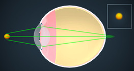 Корекция на зрението