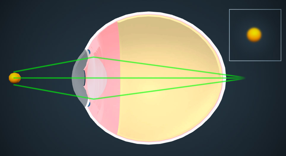Корекція зору